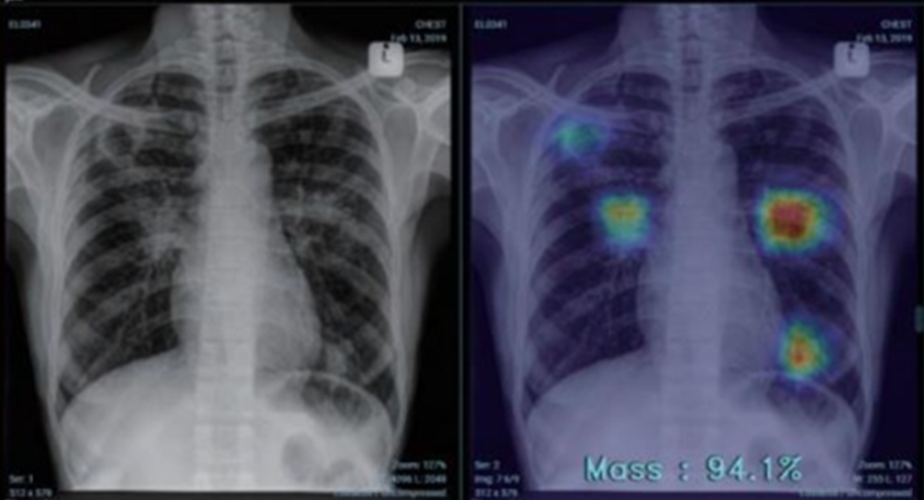 x-ray